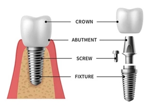 Illustration: Dental implant procedure showing implant placement, osseointegration, abutment placement, and final restoration at a dental clinic.